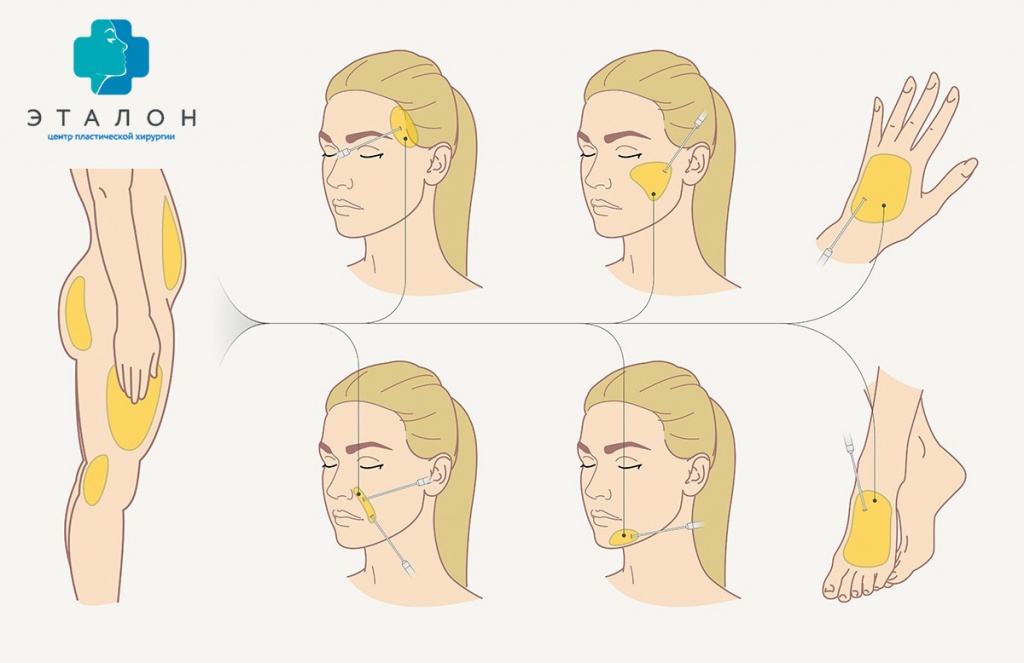 схема зон забора и введения жировой клетчатки при липофилинге