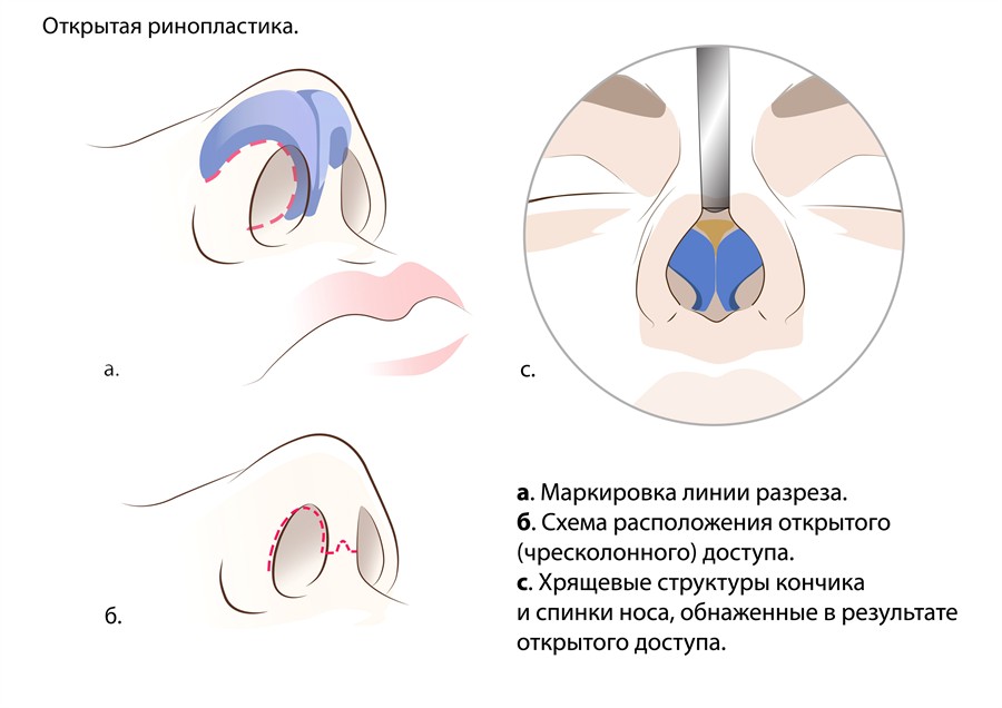 линии разреза и хрящевые структуры при открытой ринопластике
