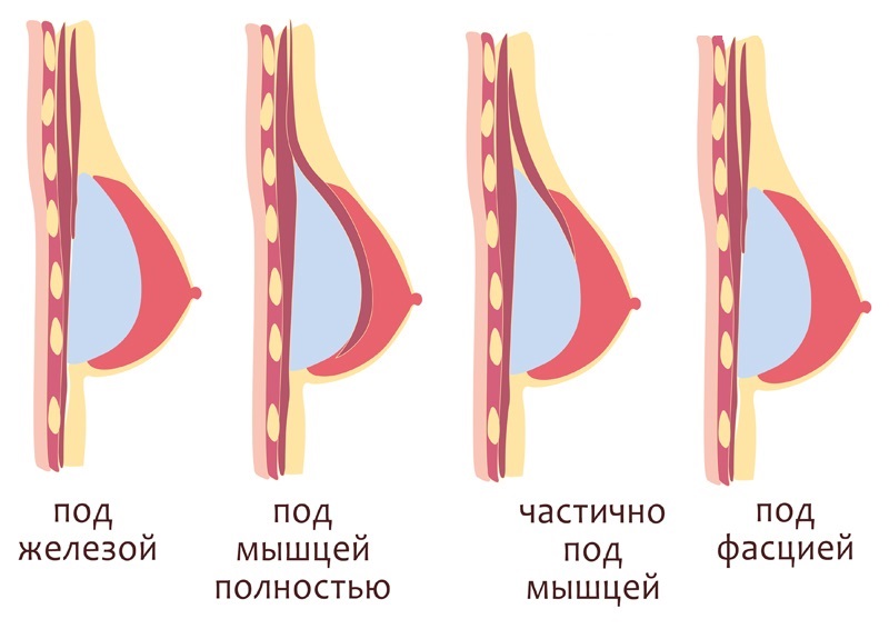 установка имплантов при увеличивающей пластике молочных желез
