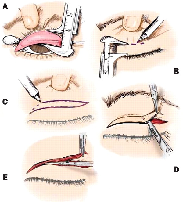 схема проведения ориентальной блефаропластики