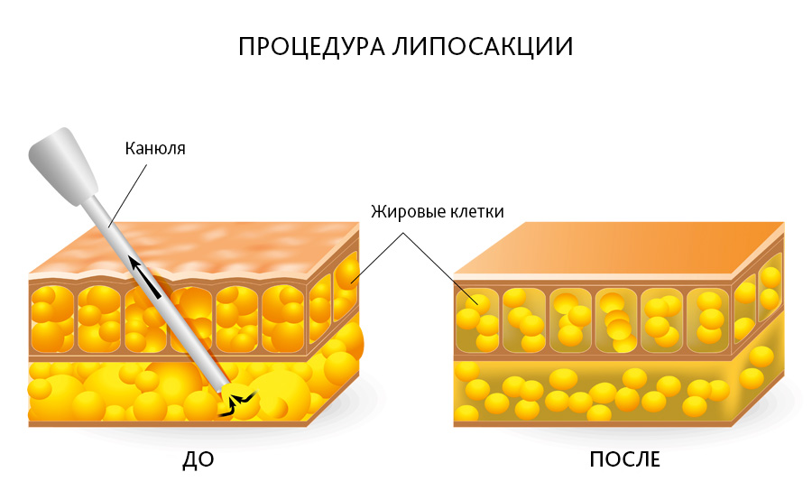 схема проведения операции по липосакции