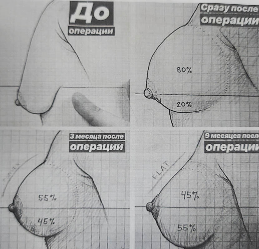 этапы реабилитации после увеличения молочных желез