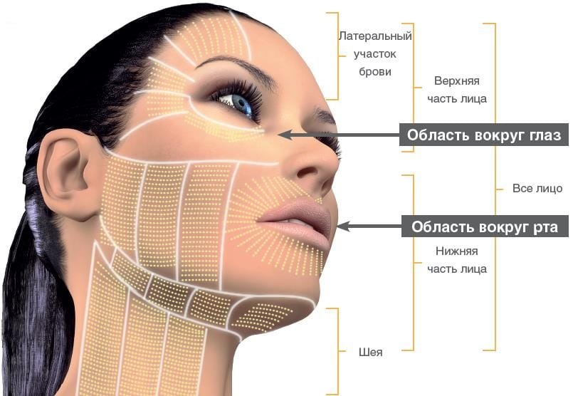 области проведения СМАС-подтяжки