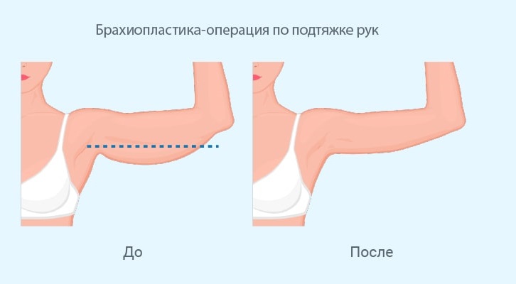 схема до/после пластики рук