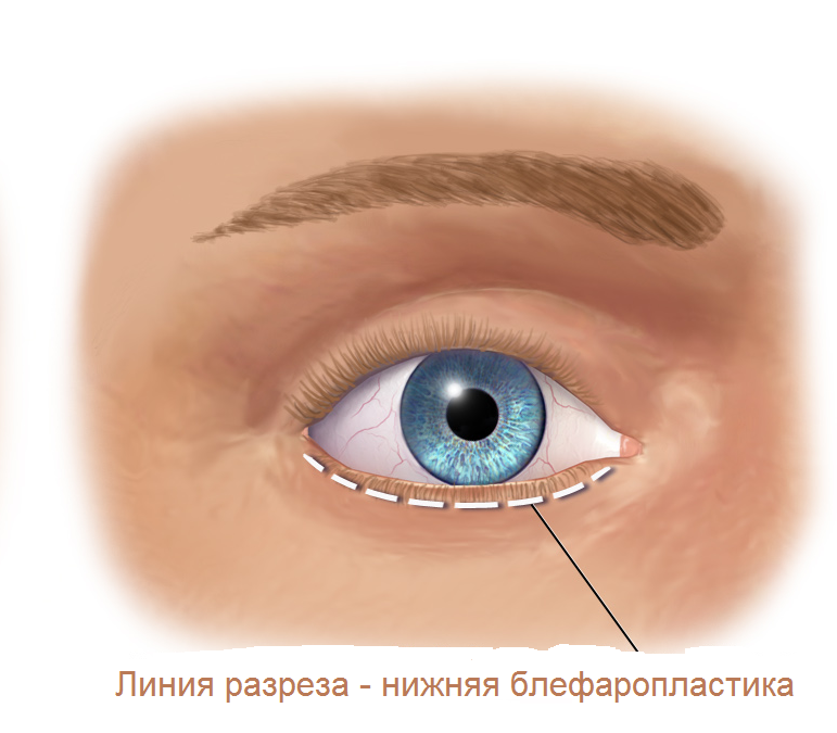 линия разреза при нижней блефаропластике