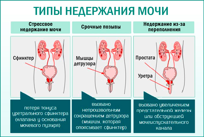 таблица типов недержания мочи у женщин