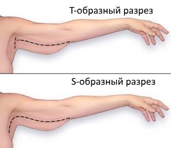 T- и S-образная форма разреза при пластике рук