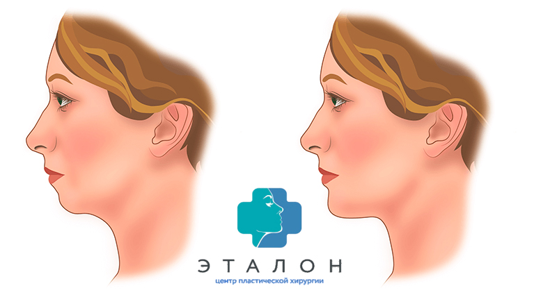 результат пластики подбородка