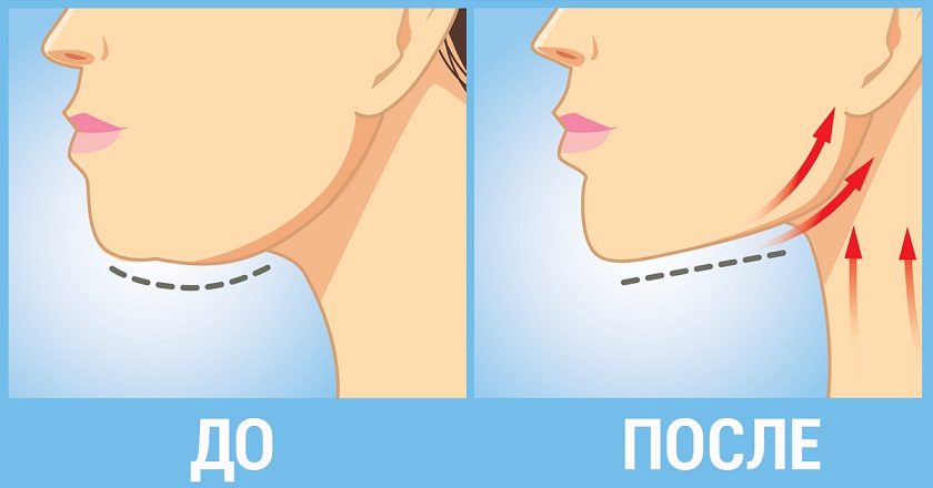 схема до/после проведенной операции по ликвидации второго подбородка
